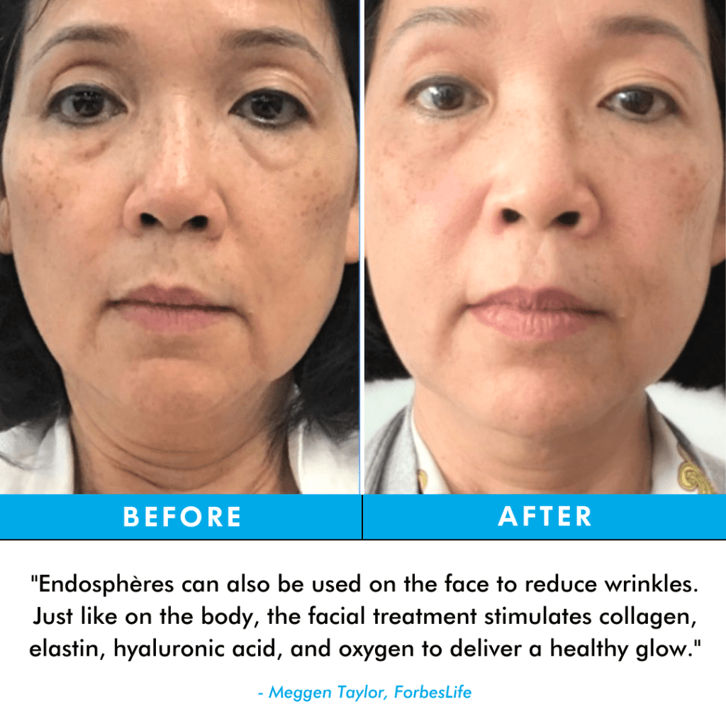 a before and after photo of endospheres therapy by Forbeslife
