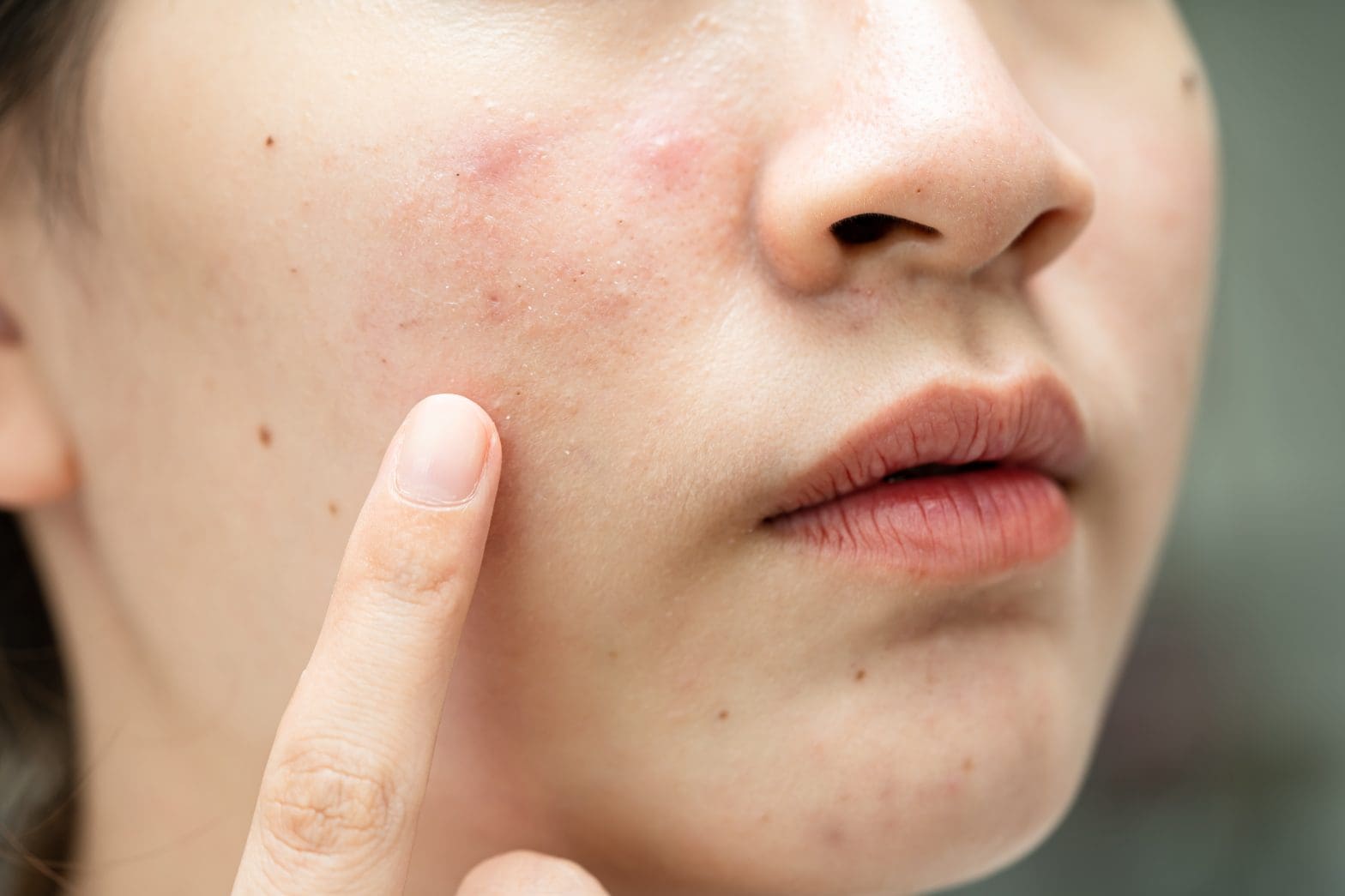 a woman pointing to acne scars on her cheek, begging the question is gua sha safe for all skin types?