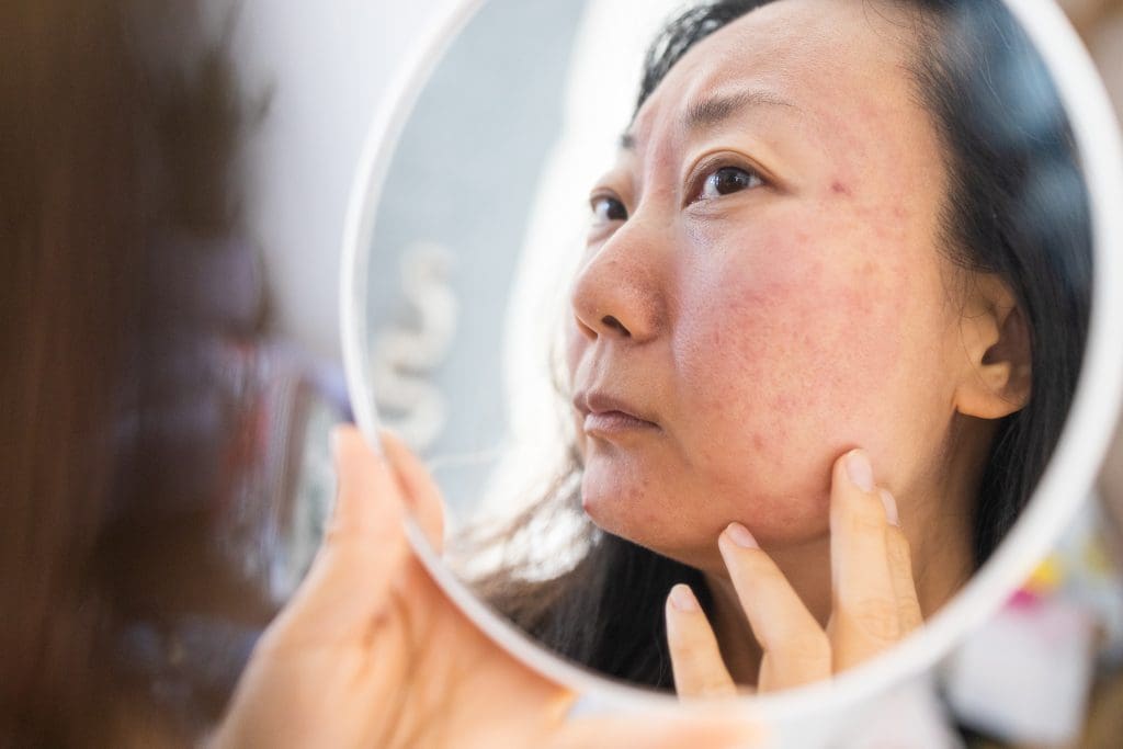 a woman looking in the mirror wondering if red light treatment for acne scars works